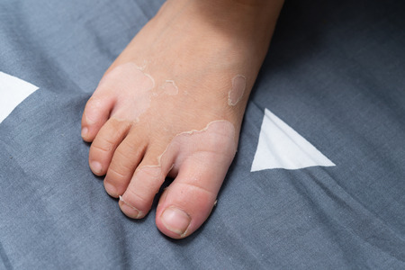 kids foot with old skins coming off