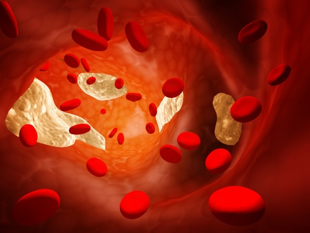 Atherosclerosis - clogged artery and erythrocytesの写真素材