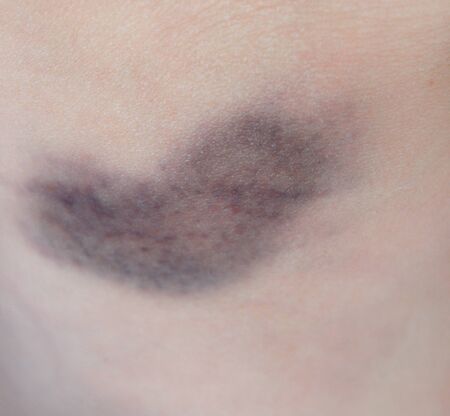 Bruise. Close-up photo