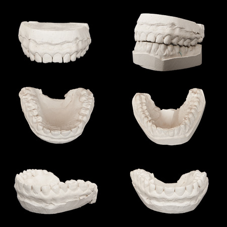 Set of Dental casting gypsum models plaster cast stomatologic human jaws. Isolated on blackの写真素材