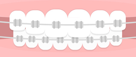 Teeth braces. Flat illustrationのイラスト素材