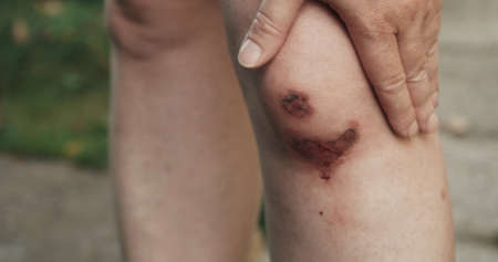Upset woman has a black eye. The concept of domestic violence, discrimination against women and...