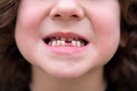 mouth of a small child who has moved a baby tooth and is growing the tooth