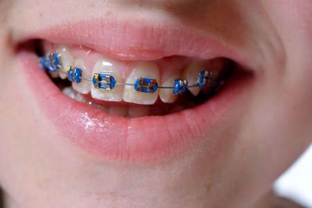 brace