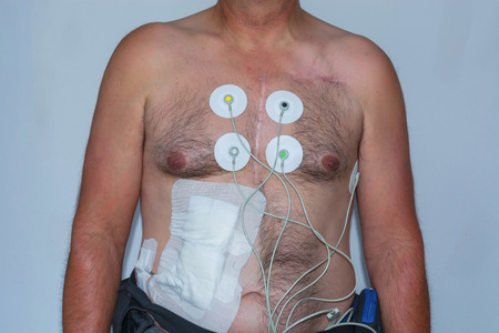 Naked upper body of a man with electrodes for measuring the heart tension curve for an...