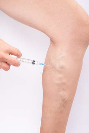 varicose vein treatment, injection into a sore leg.
