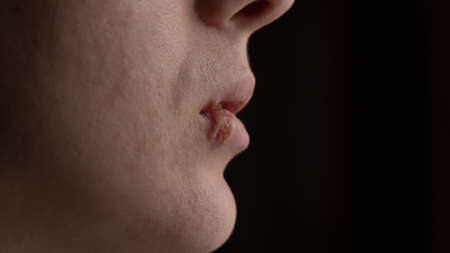herpes on the lips, a woman with a sore on the lipの写真素材