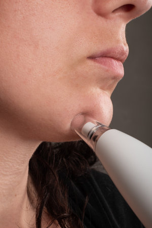 woman with vacuum face pore cleaner, skin care
