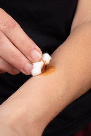 decontamination of a snake bite wound with iodine solution, medical treatment hand from poison.の写真素材