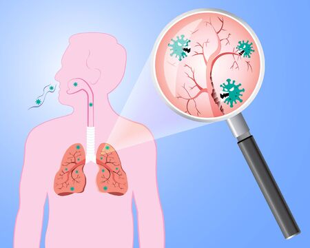 Damaged from Coronavirus cells with magnifying glass inspecting the affected on lung. COVID-19 with scary and evil face eating lung. 2019-nCoV concept.のイラスト素材