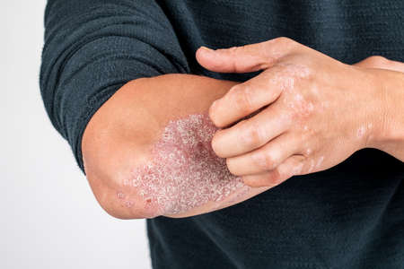 Man with sick hands, dry flaky skin on his hand with vulgar psoriasis, eczema and other skin...