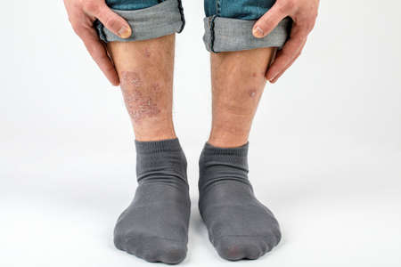 Close-up of the legs of a man suffering from chronic psoriasis on a white backgroundの写真素材