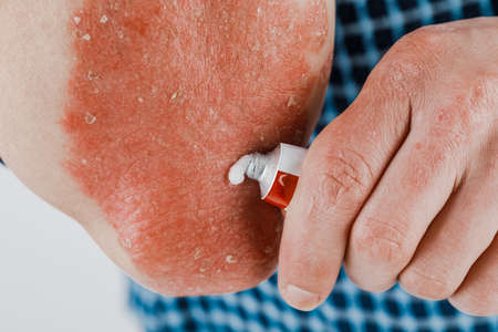 Application of emollient on dry skin, as in the treatment of psoriasis, eczema and other dry skin