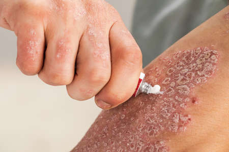 the use of emollient for dry flaky skin, as in the treatment of psoriasis, eczema and other diseases of dry skinの写真素材