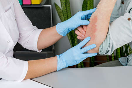 A dermatologist wearing gloves examines the skin of a sick patient. Examination and diagnosis of skin diseases-allergies, psoriasis, eczema, dermatitis.の写真素材