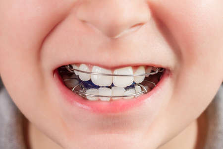 Child with orthodontic appliance close-upの写真素材