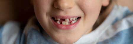 Wide closeup view image of a cute toddler boy smiling with three of his baby teeth missing.