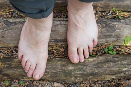 Natural physiotherapy for flat feet. Female feet on the logs as prevention against flatfoot