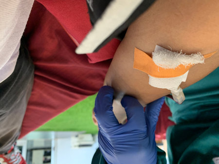 Patient with saline intravenous (IV) on his arm.