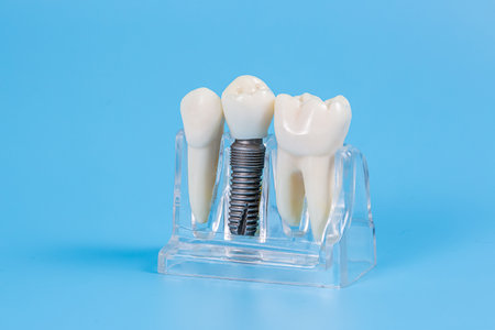 Plastic dental crowns, imitation of a dental prosthesis of a dental bridge for three teeth with a metal screw implant on a blue background.の写真素材