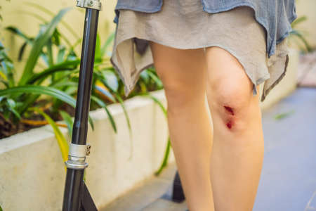 Young woman with a wound on her knee fell off a scooterの写真素材