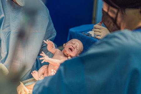 A baby is delivered during a caesarean section. The surgical procedure is conducted in a sterile operating room with a skilled medical team, ensuring the safety and health of both mother and babyの写真素材