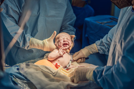 A baby is delivered during a caesarean section. The surgical procedure is conducted in a sterile operating room with a skilled medical team, ensuring the safety and health of both mother and babyの写真素材