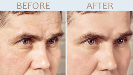 Face of a mature man before and after cosmetic rejuvenating proceduresの写真素材