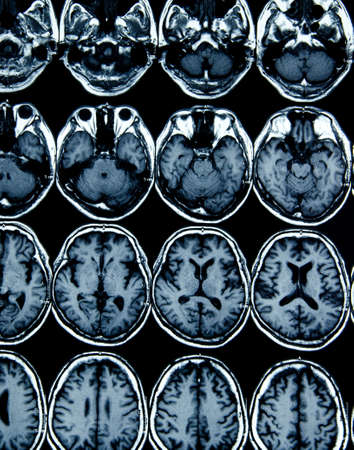 MRI scan image of brain for diagnosisの写真素材
