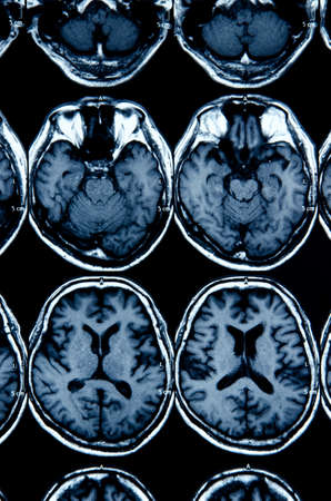 MRI scan image of brain for diagnosisの写真素材