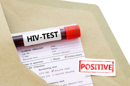 Blood sample with HIV test positive and request laboratory form on white background.の写真素材
