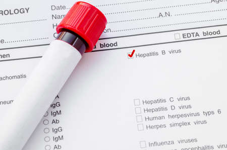 Blood sample for hepatitis B virus (HBV) testing on request form screening test.の写真素材