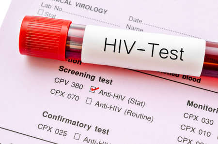 Sample blood collection tube with HIV test label on HIV infection screening test form.の写真素材