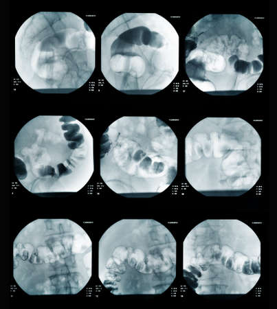 picture of intestinal abdominal xrayの写真素材