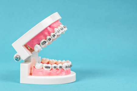 Tooth model with metal wire dental braces on blue  with empty space for your text or message.の写真素材