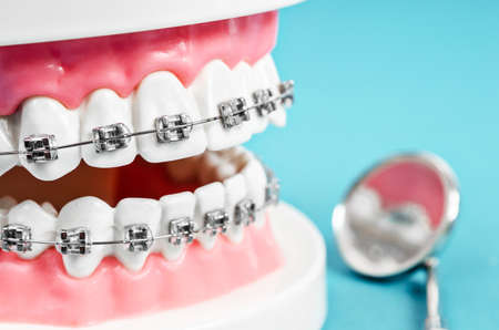 Close up tooth model with metal wire dental braces and mirror dental equipment on blueの写真素材
