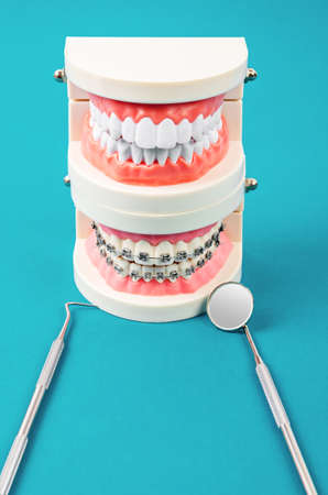 Compare tooth model and tooth model with metal wire dental braces and equipment on blue