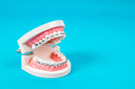Tooth model with metal wire dental braces on blue  with empty space for your text or message.の写真素材