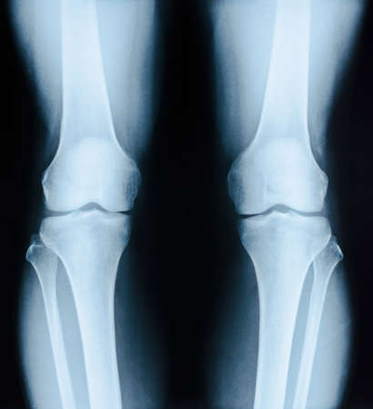 x-ray image patient with degenerative change of knee joint on black background.