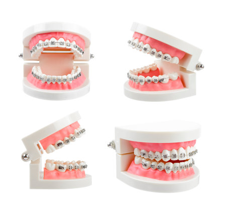 Set teeth model with metal wire dental braces or dental instruments isolated on white backgroundの写真素材