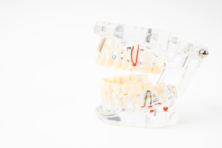 Dentures model, abutment and human teeth and dentures on white background.の写真素材