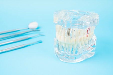 Human jaw or Acrylic dentures model with implants and dental tools on blue background.の写真素材
