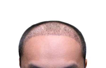 Top view of a man's head with hair transplant surgery with a receding hair line. -  After Bald head...
