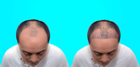 Close up top view of a man's head with hair transplant surgery with a receding hair line. before and...