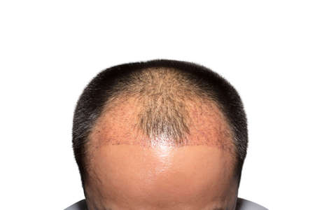 Close up top view of a man's head with hair transplant surgery with a receding hair line isolated on White Background -  2 months after Bald head of hair loss treatment.の写真素材