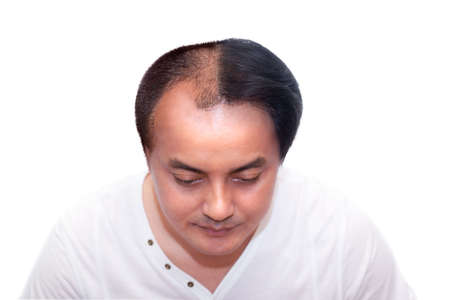 Close up top view of a man's head with hair transplant surgery with a receding hair line. before and after bald head of a man . After Bald head of hair loss treatment on white backgroundの写真素材