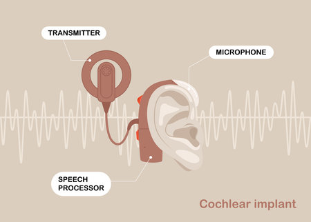 Treatment and prosthetics of hearing loss in otolaryngology. Cochlear hearing aids behind the ear, on background of sound wave diagram.のイラスト素材