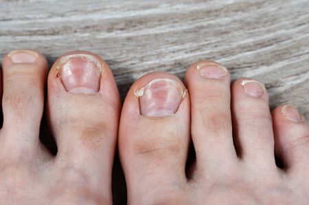 dirty toes with hair and ingrown cracked nails. corns and dry skin on toes. medical pedicure. nail fungus treatmentの写真素材