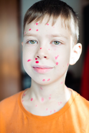 <p>portrait of a 10-year-old boy with chickenpox and a rash on his face smeared with furacilin</p>の写真素材