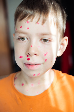 portrait of a 10-year-old boy with chickenpox and a rash on his face smeared with furacilinの写真素材